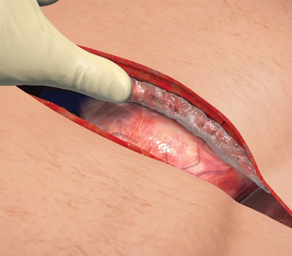 Ostene being applied to the sternal edge
