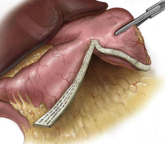Staple line reinforcement with PSDV in sleeve gastrectomy