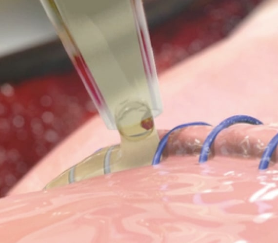 Preveleak being applied to the suture line
