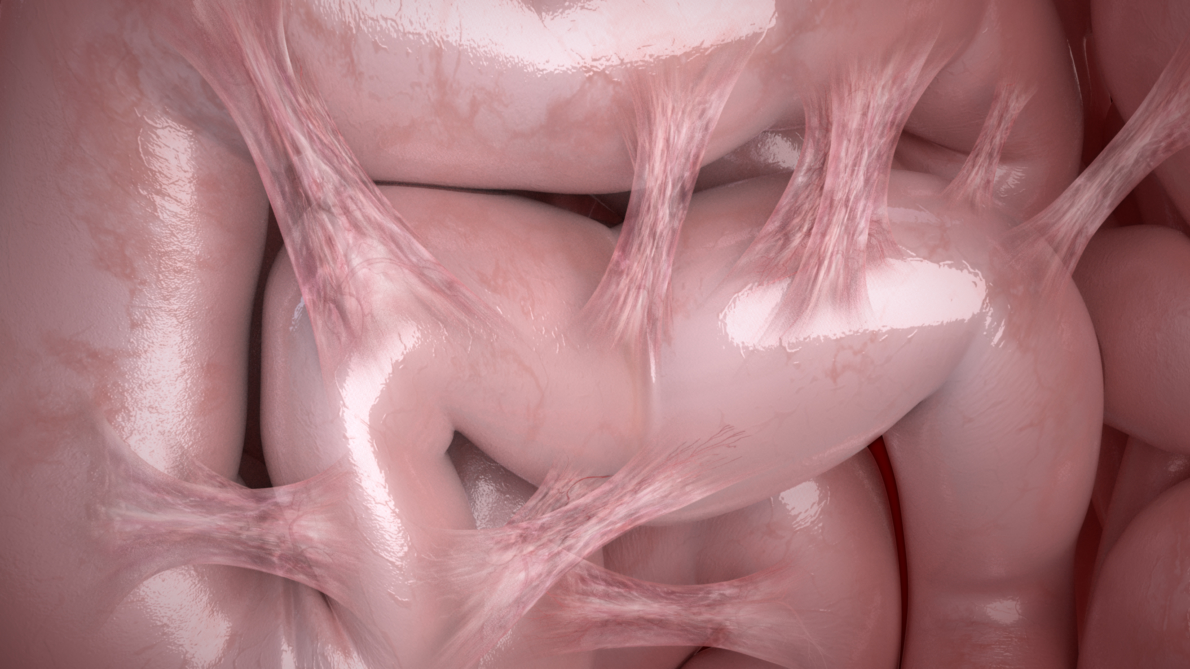 Intestines Adhesions