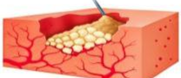 Floseal Matrix is applied to the tissue surface at the base of the lesion; its granules fill the wound and conform to its shape.