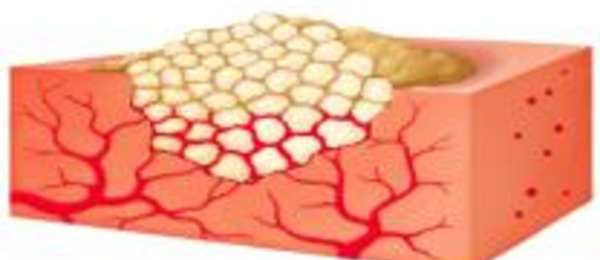 Floseal Matrix granules expand approximately 10-20% within about 10 minutes and physically restrict the flow of blood. Blood percolates through the spaces and is exposed to thrombin.
